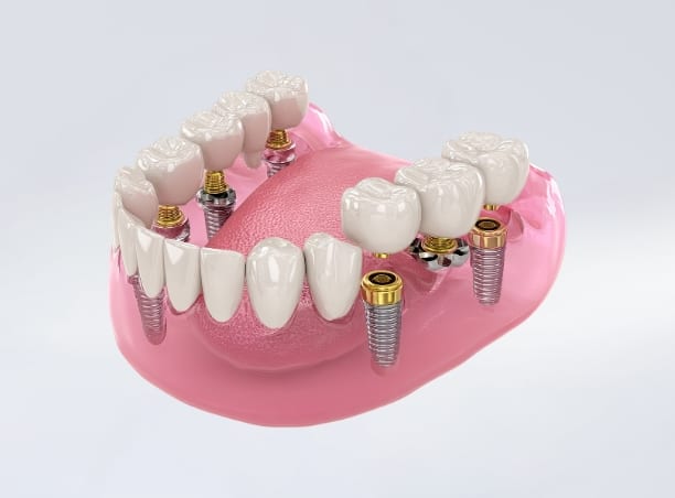 Festsitzender Zahnersatz auf Implantaten