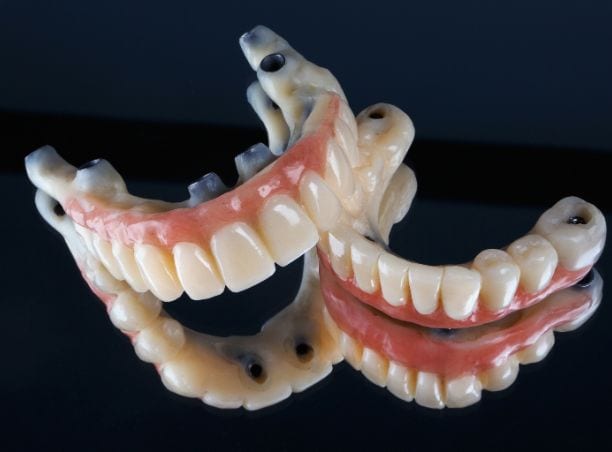 What is fixed dentures on implants and how does it work?