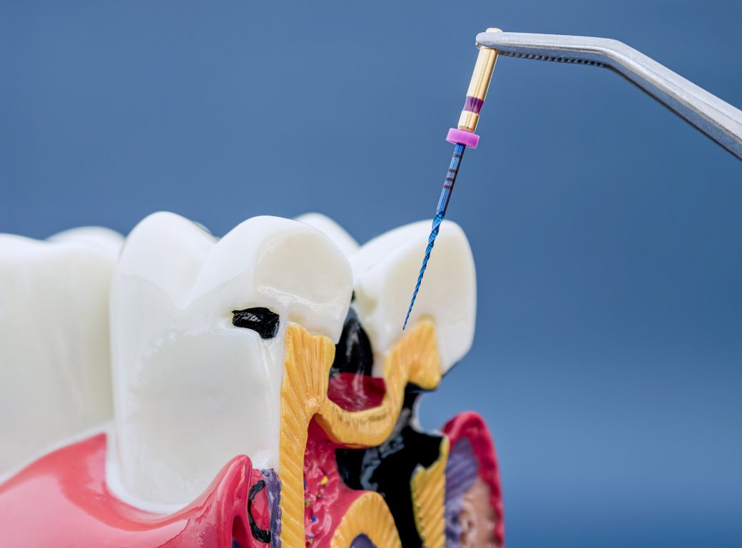 Qu’est-ce que l’endodontie au microscope et pourquoi la précision est-elle importante ?