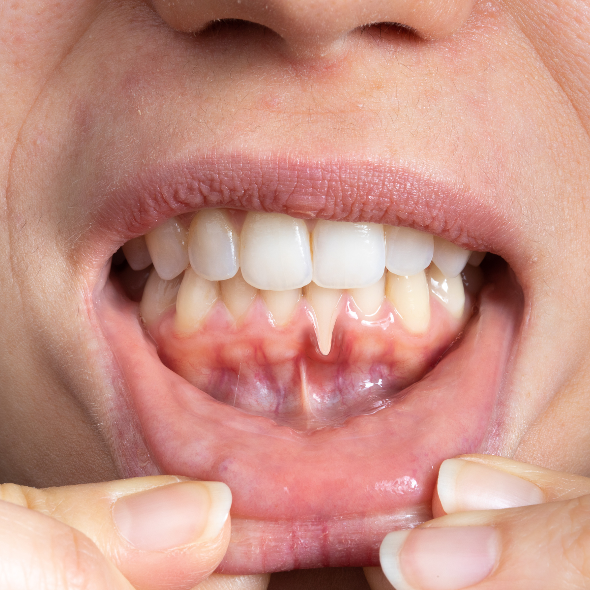 ¿Qué es la enfermedad periodontal y por qué el láser marca la diferencia?